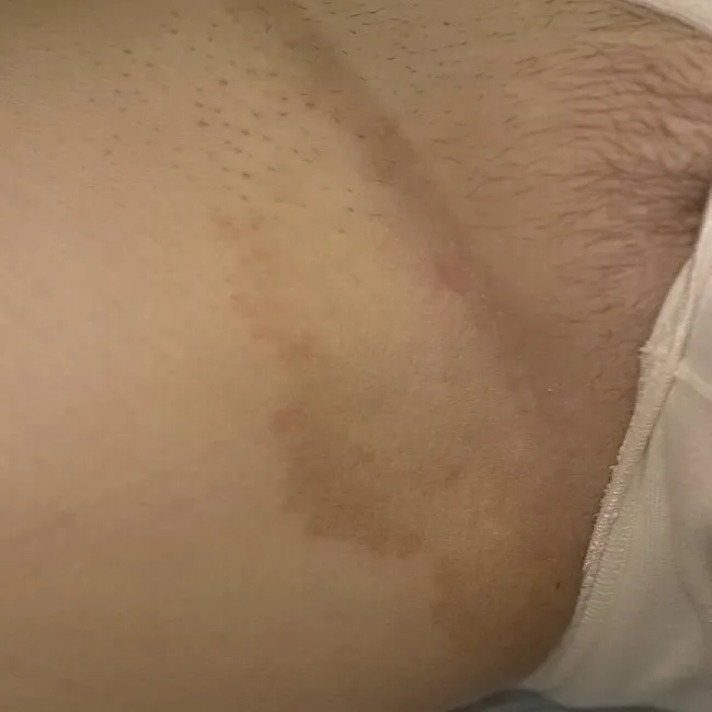 pachwina udowa swędzenie erythrasma 