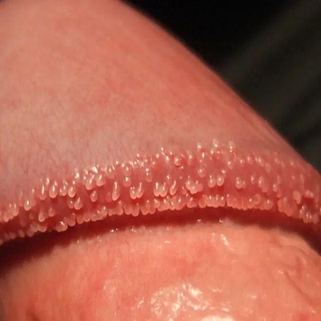pearly penile papules