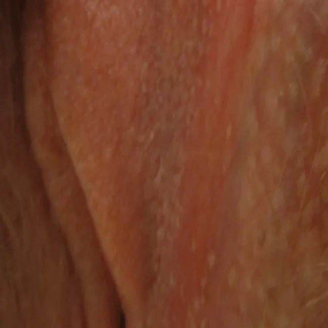 plamki fordyce'a wargi sromowe