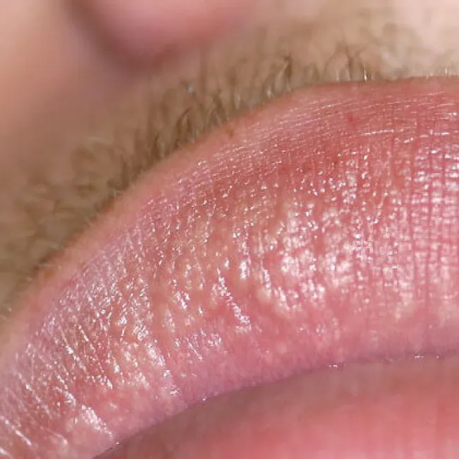 plamki fordyce'a zdjęcia