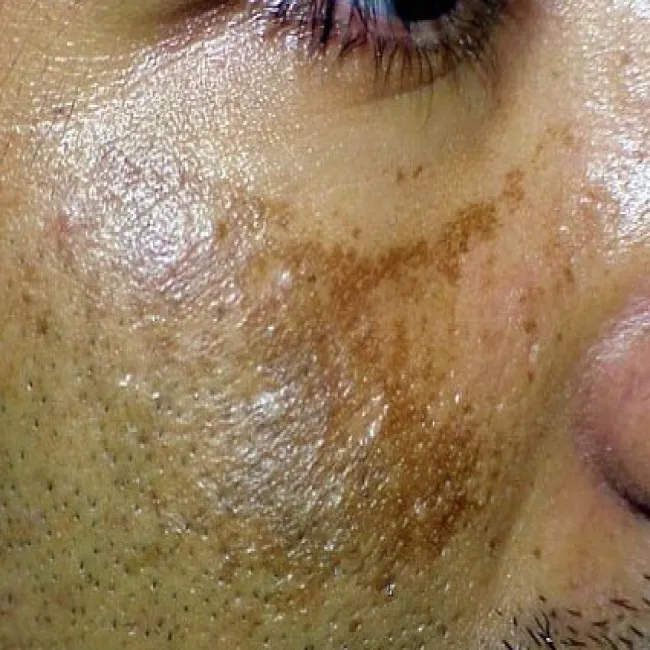 plamy na skórze zdjęcia