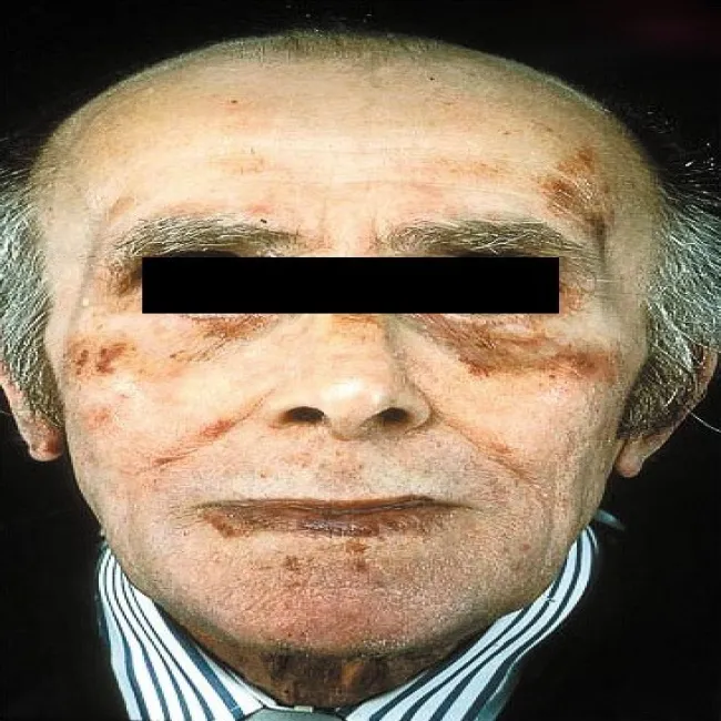 plamy wokół oczu ust na czole amyloidozy skóry