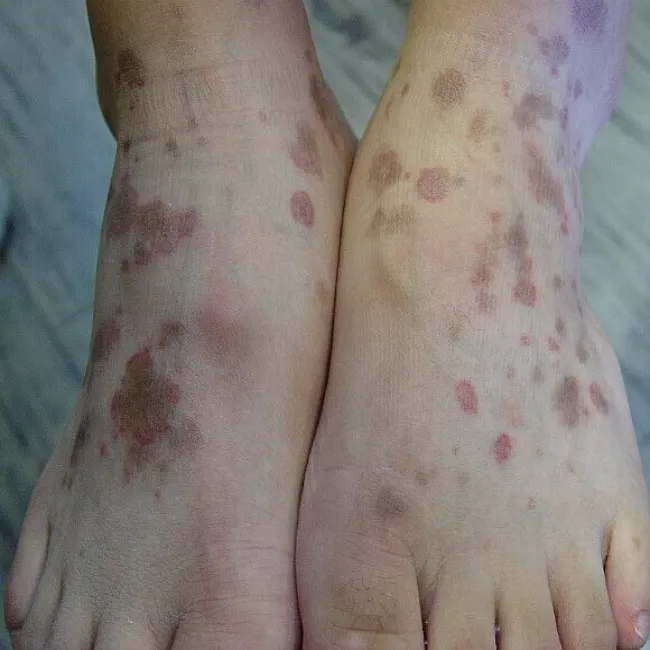 plamy na skórze stóp