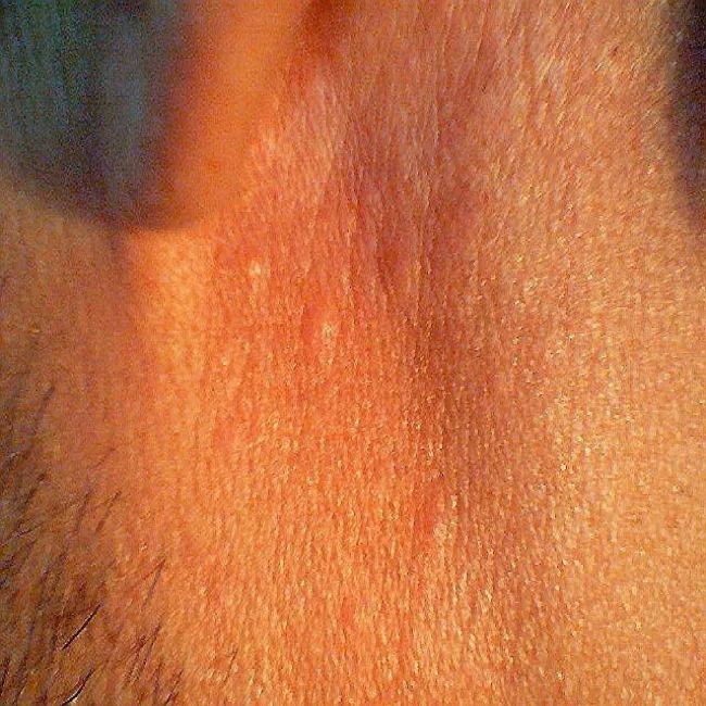 pokrzywka cholinergiczna na twarzy