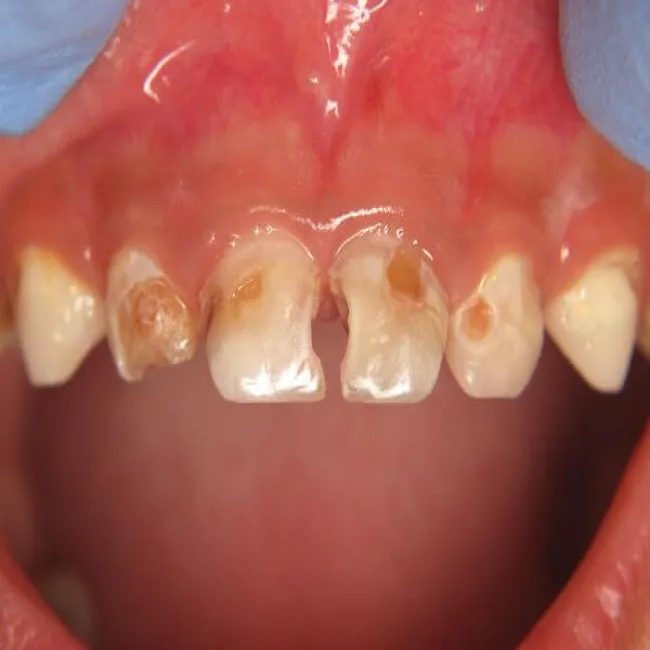 próchnica butelkowa u dzieci