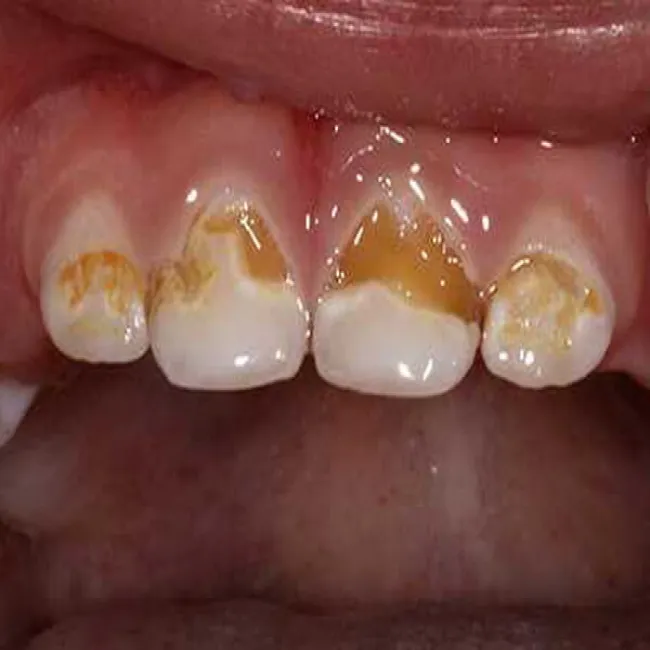 próchnica butelkowa u rocznego dziecka