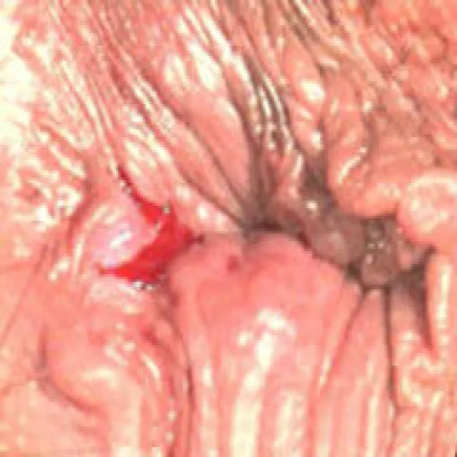 proktologiczne choroby szczelina odbytu 