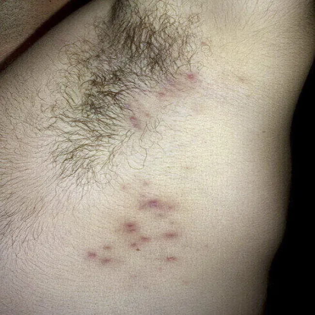 pryszcze pod pachami zapalenie mieszków włosowych