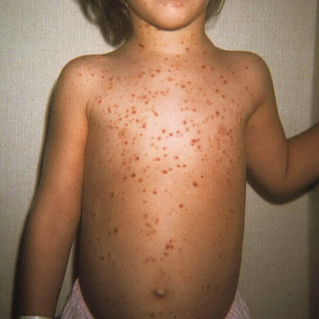 przyłuszczyca u dzieci