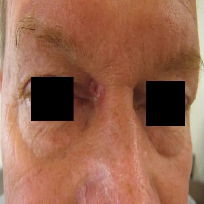 rak podstawnokomórkowy skóry okolice oko