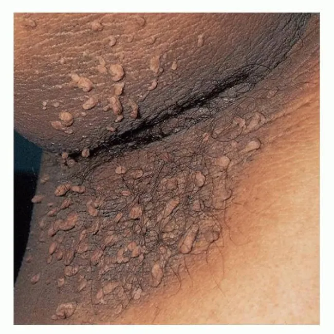 rogowacenie ciemne skóry