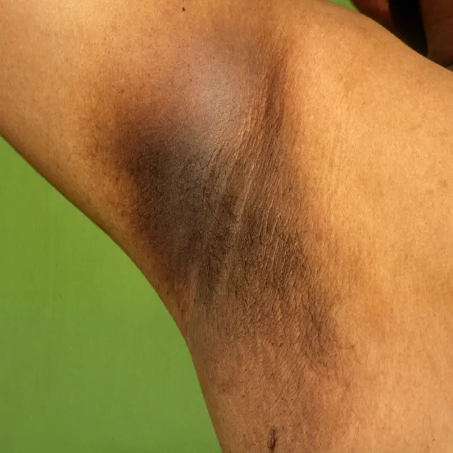 rogowacenie ciemne zdjęcia