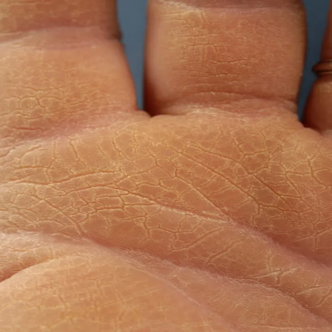 rogowacenie skóry zdjęcia