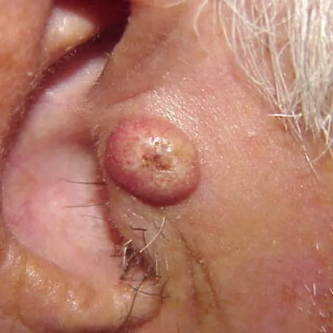 rogowiak kolczystokomórkowy obrazy