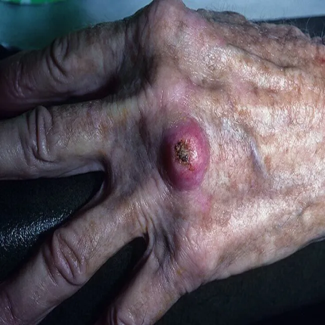 rogowiak kolczystokomórkowy zdjęcia