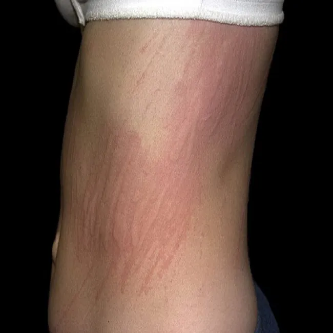 rumień na skórze pokrzywka dermograficzna