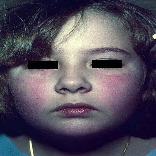 rumień zakaźny zdjęcie