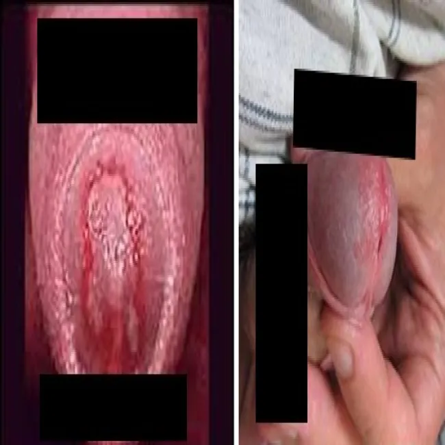 rzęsistkowica u mężczyzn