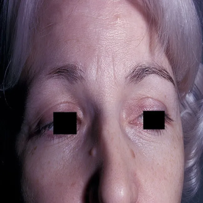 rzadkie brwi łysienie plackowate