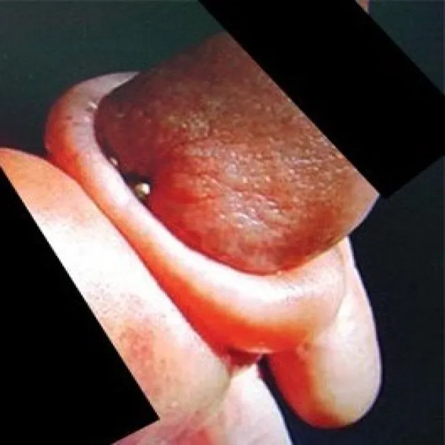 spuchnięty zaczerwieniony napletek