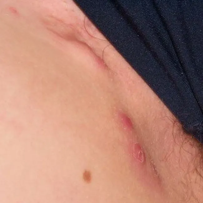 stan zapalny w pachwinie