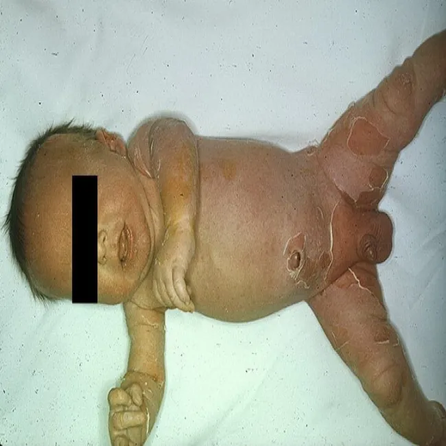 staphylococcal scalded-skin syndrome