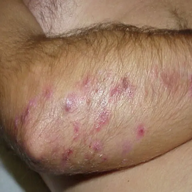 swędzące zmiany skórne zdjęcia opryszczkowate zapalenie skóry