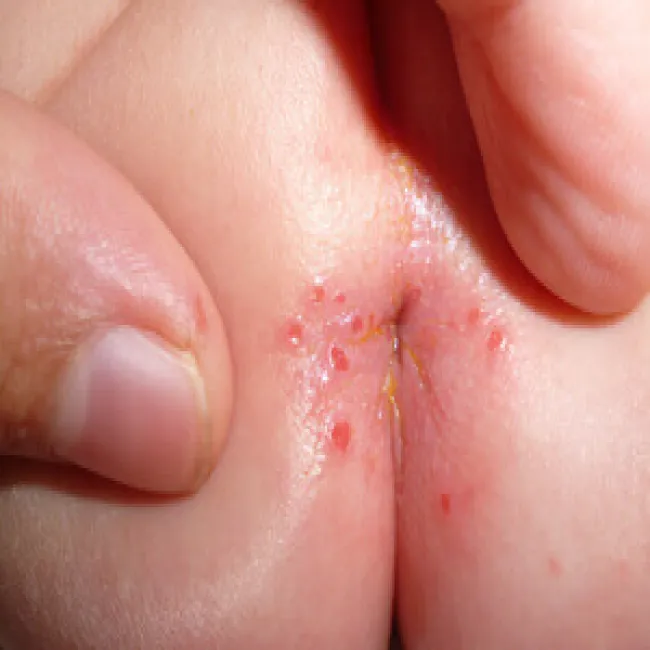 szczelina odbytu u dzieci