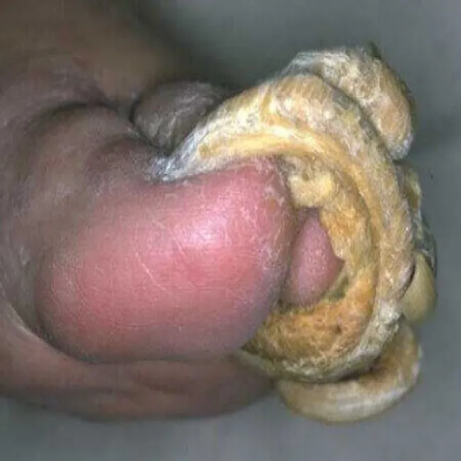 szponowate paznokcie