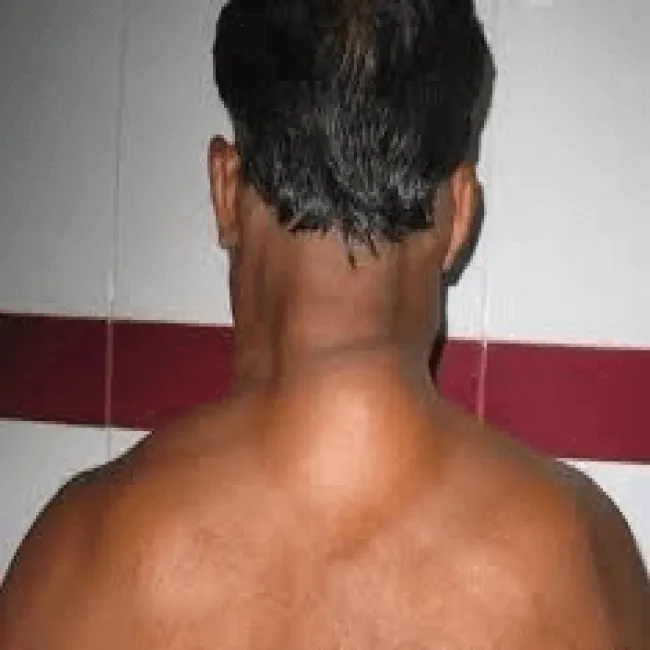 Tłuszczak szokujące zdjęcia 