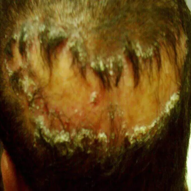 tinea favosa capitis