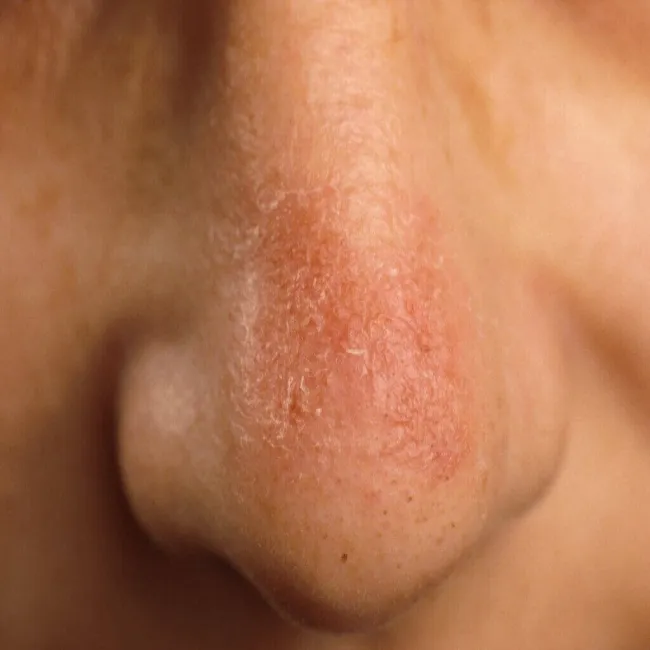 Toczeń rumieniowaty krążkowy zdjęcie na nosie