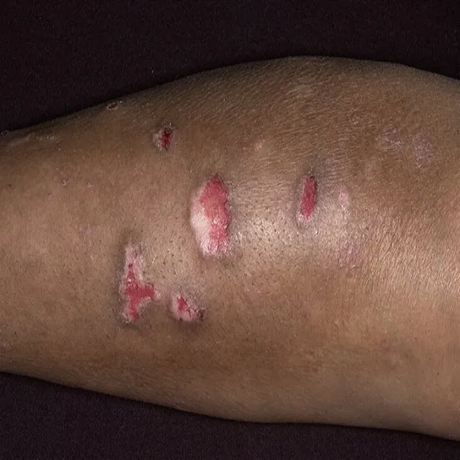 toczeń rumieniowaty na rękach