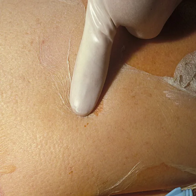 toksyczne martwicze oddzielanie się naskórka