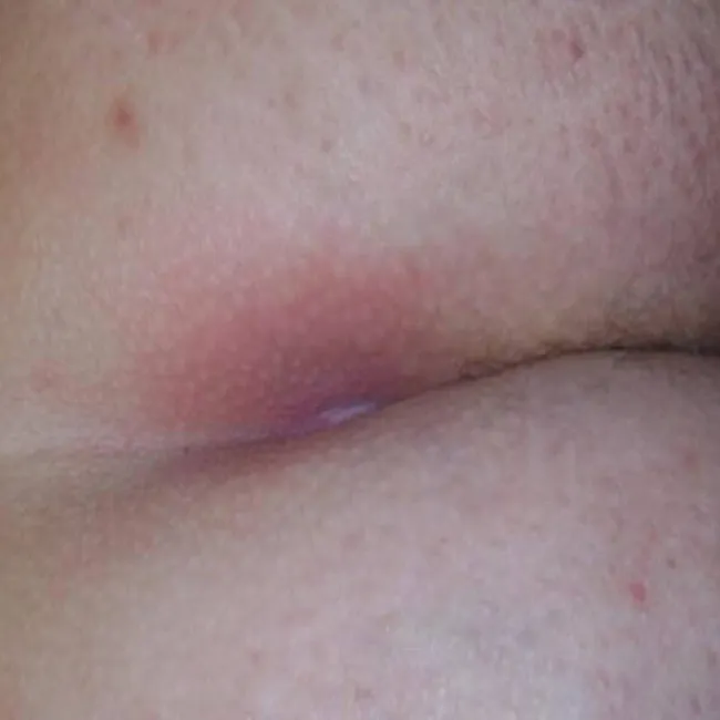 torbiel włosowa jak wygląda