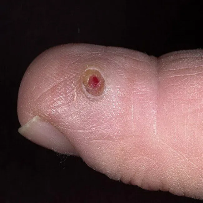 twardy guzek na palcu