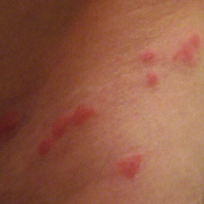 ugryzienie wszy zdjęcia