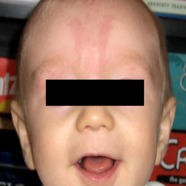 uszczypnięcie bociana na czole