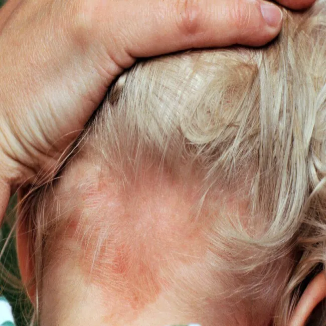 uszczypnięcie bociana na karku