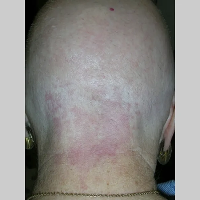 uszczypnięcie bociana u dorosłych 