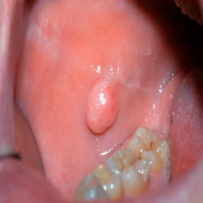włókniak w jamie ustnej jak wygląda