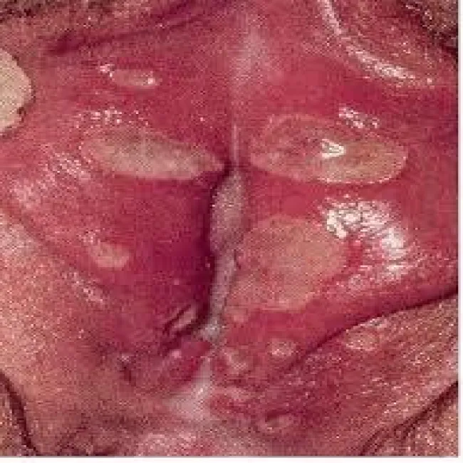 wargi sromowe choroby zdjęcia wrzód weneryczny