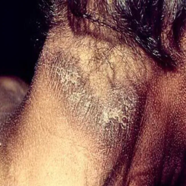 witamina pp niedobór objawy