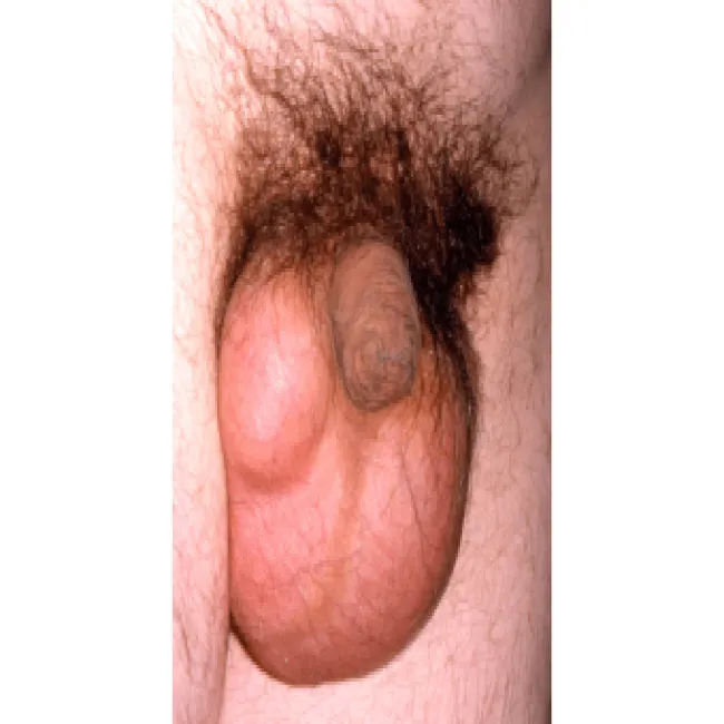 wodniak jądra u dorosłego