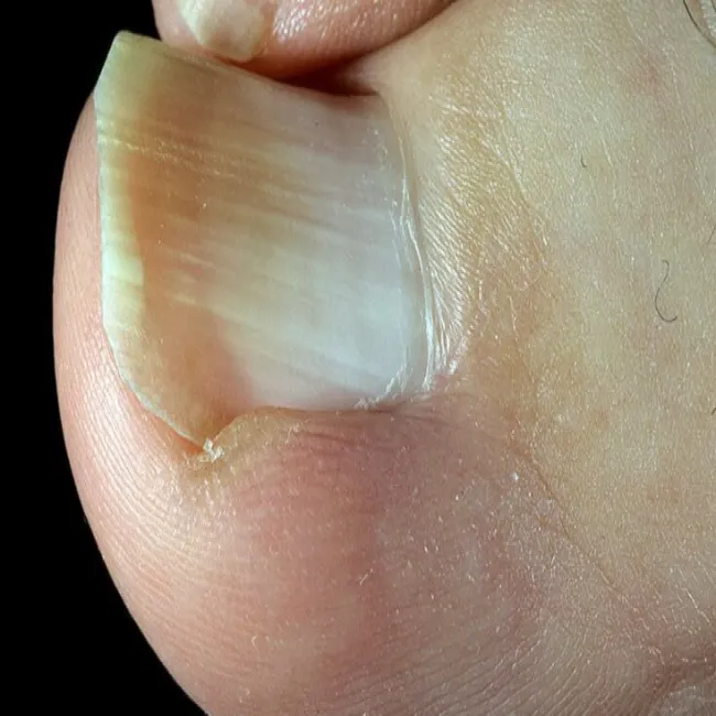 wrastający paznokieć