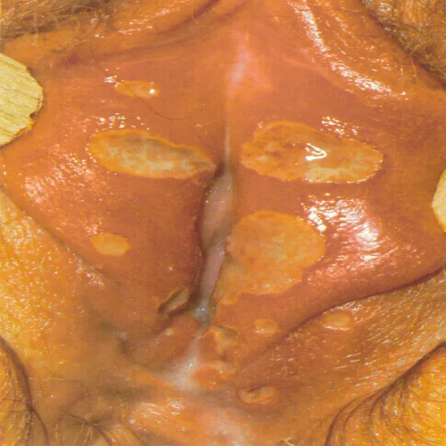 wrzód weneryczny szankier warg sromowych