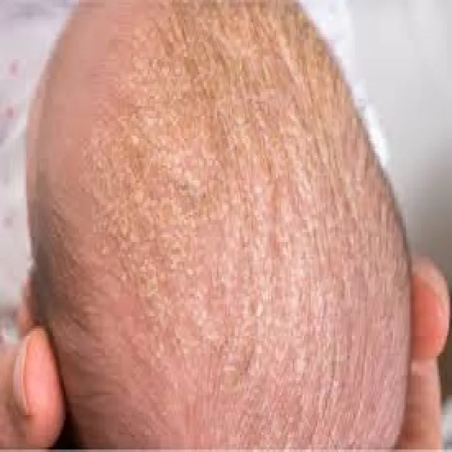 wyprysk łojotokowy u dziecka na głowie