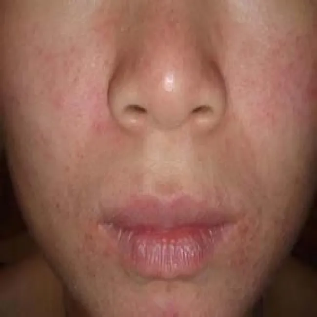 wyprysk łojotokowy u dziecka