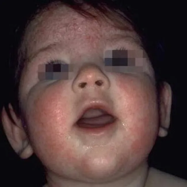 wyprysk kontaktowy na twarzy u dziecka