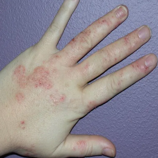 wyprysk mikrobowy na dłoni